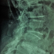 spondilolistesi